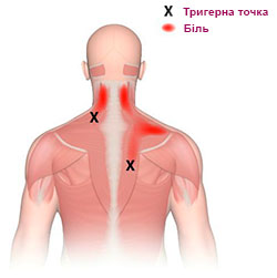 Міофасціальний больовий синдром. Від тригерних точок до ...