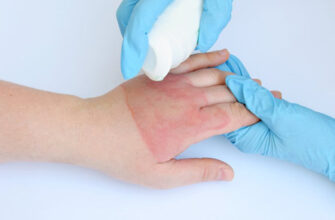 Ефективні методи лікування опіків: огляд засобів та рекомендації