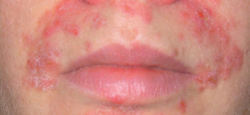 Ефективні методи лікування періорального дерматиту: поради та засоби