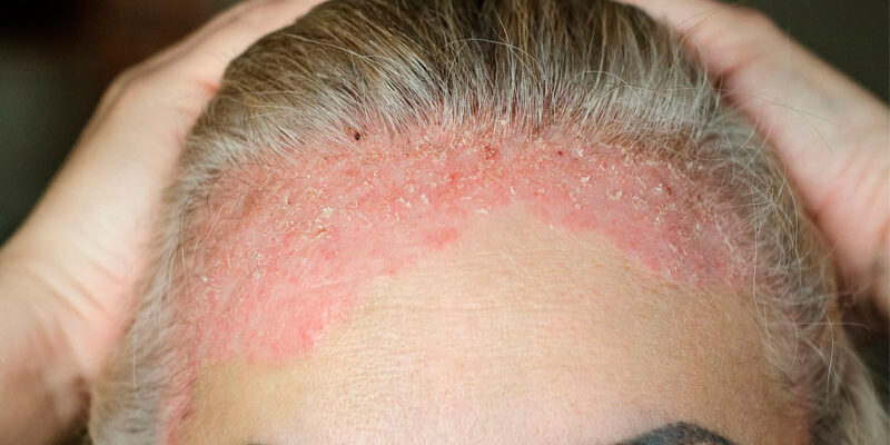 Ефективні методи лікування псоріазу на голові: поради та засоби