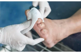 Ефективні методи лікування ран на ногах при цукровому діабеті