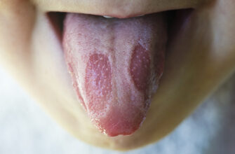 Ефективні методи лікування рани на язиці: поради та засоби