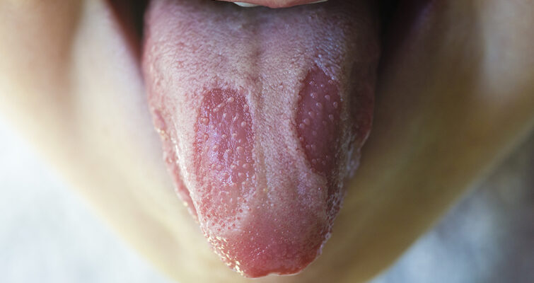 Ефективні методи лікування рани на язиці: поради та засоби