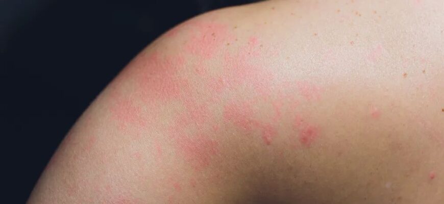 Ефективні методи лікування рожевого лишаю: практичні поради Ефективні методи лікування рожевого лишаю: практичні поради