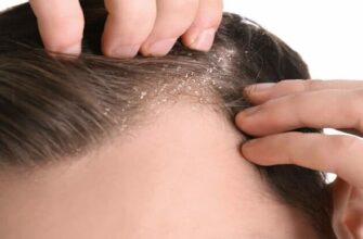 Ефективні методи лікування себорейного дерматиту шкіри голови