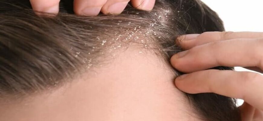 Ефективні методи лікування себорейного дерматиту шкіри голови