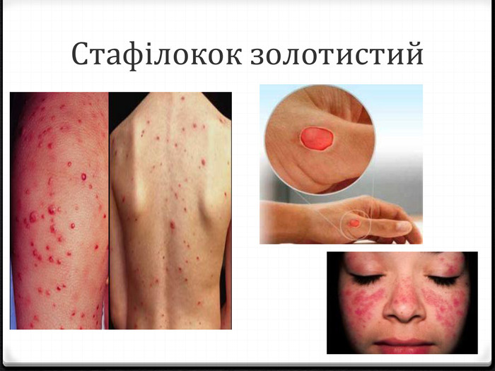 Лікування стафілокока - купити таблетки, капсули, мазь від ...