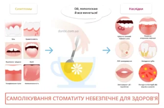 Ефективні методи лікування стоматиту в домашніх умовах