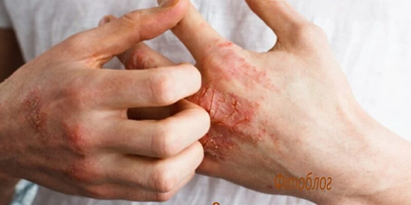 Ефективні методи лікування стрептодермії: поради та рекомендації