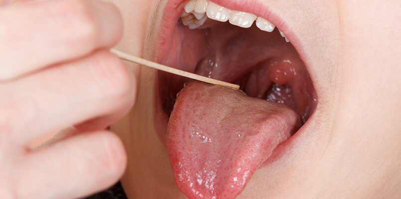 Ефективні методи лікування тонзиліту у дорослих: перевірені засоби