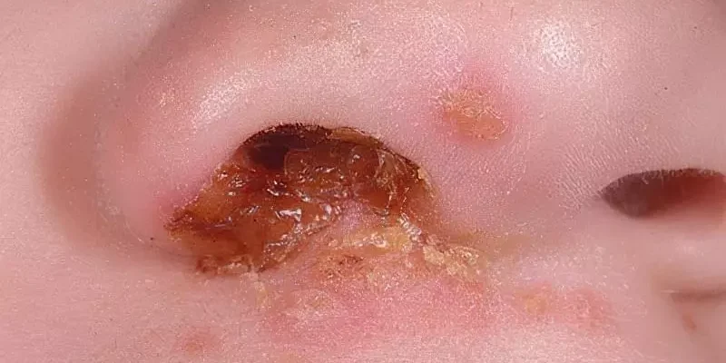 Ефективні методи лікування вавок у носі: поради та засоби