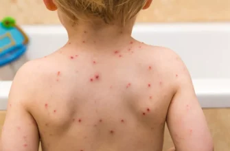 Ефективні методи лікування вітрянки: поради та рекомендації лікарів