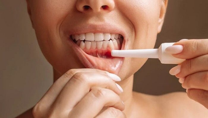 Ефективні методи лікування виразок у роті: найкращі засоби та поради