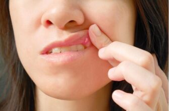 Ефективні методи лікування виразок у роті: поради та засоби