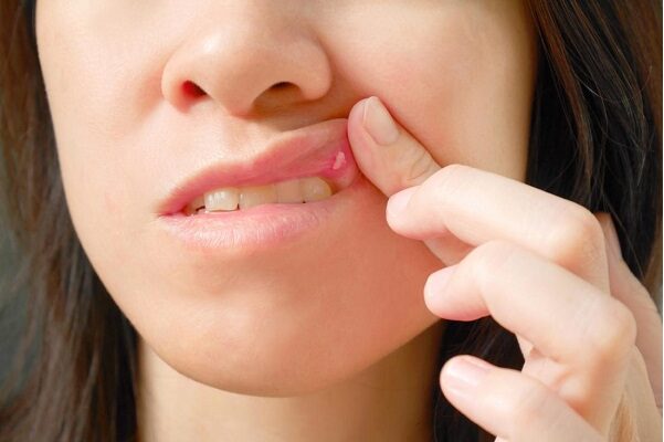 Ефективні методи лікування виразок у роті: поради та засоби