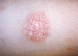 Лишай – лікування в Кривому Розі, дерматолог на Поштовому та Філатова