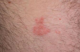 Ефективні методи лікування висівкоподібного лишаю: поради та засоби