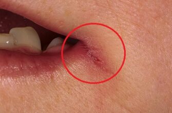 Ефективні методи лікування заїдів у куточках рота: поради та засоби