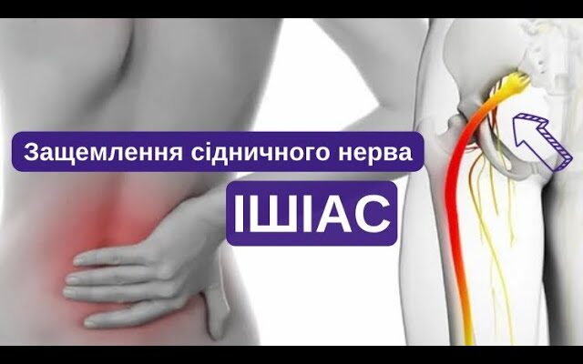 Ефективні методи лікування защемлення сідничного нерва: поради та засоби