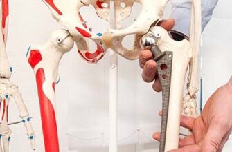 Ефективні методи подолання кульгавості після ендопротезування суглобів