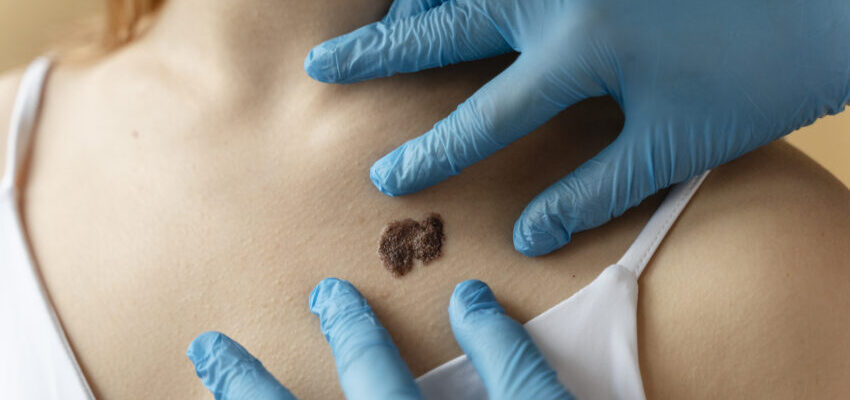 Ефективні методи та засоби для виведення бородавок в домашніх умовах