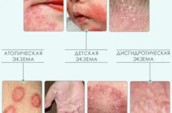 Ефективні методи та засоби лікування екземи: рекомендації для кожного