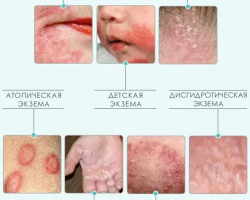 Ефективні методи та засоби лікування екземи: рекомендації для кожного