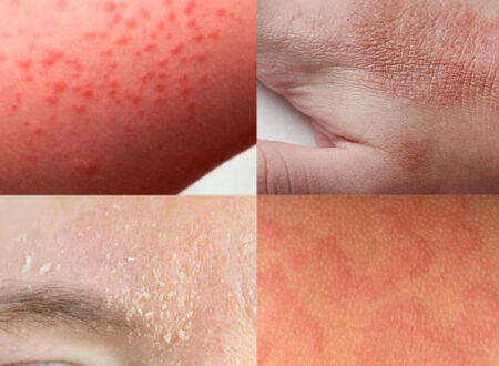 Що таке екзема та як лікувати у м Рівне?