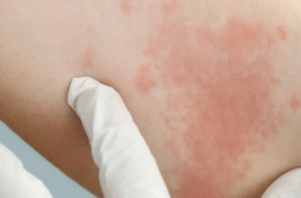 Ефективні методи та засоби лікування кропив’янки: повний гід