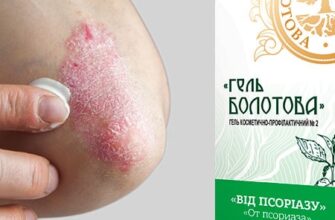 Ефективні методи та засоби лікування псоріазу в домашніх умовах