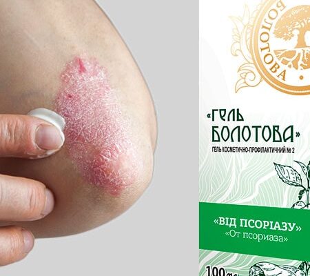 Ефективні методи та засоби лікування псоріазу в домашніх умовах