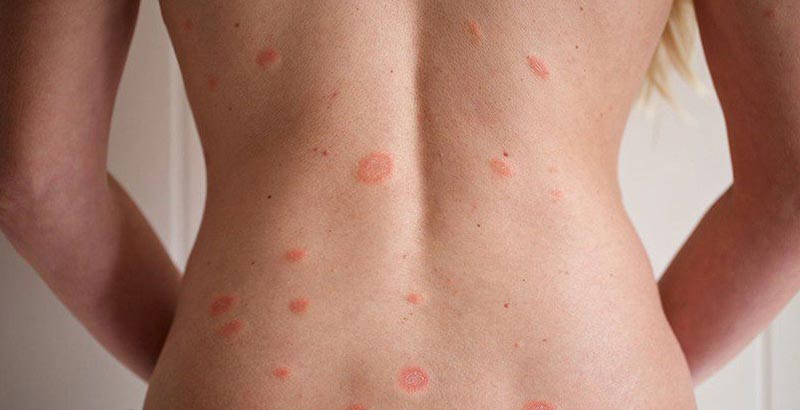 Лишай у людини - симптоми та лікування в домашніх умовах - FitoBlog