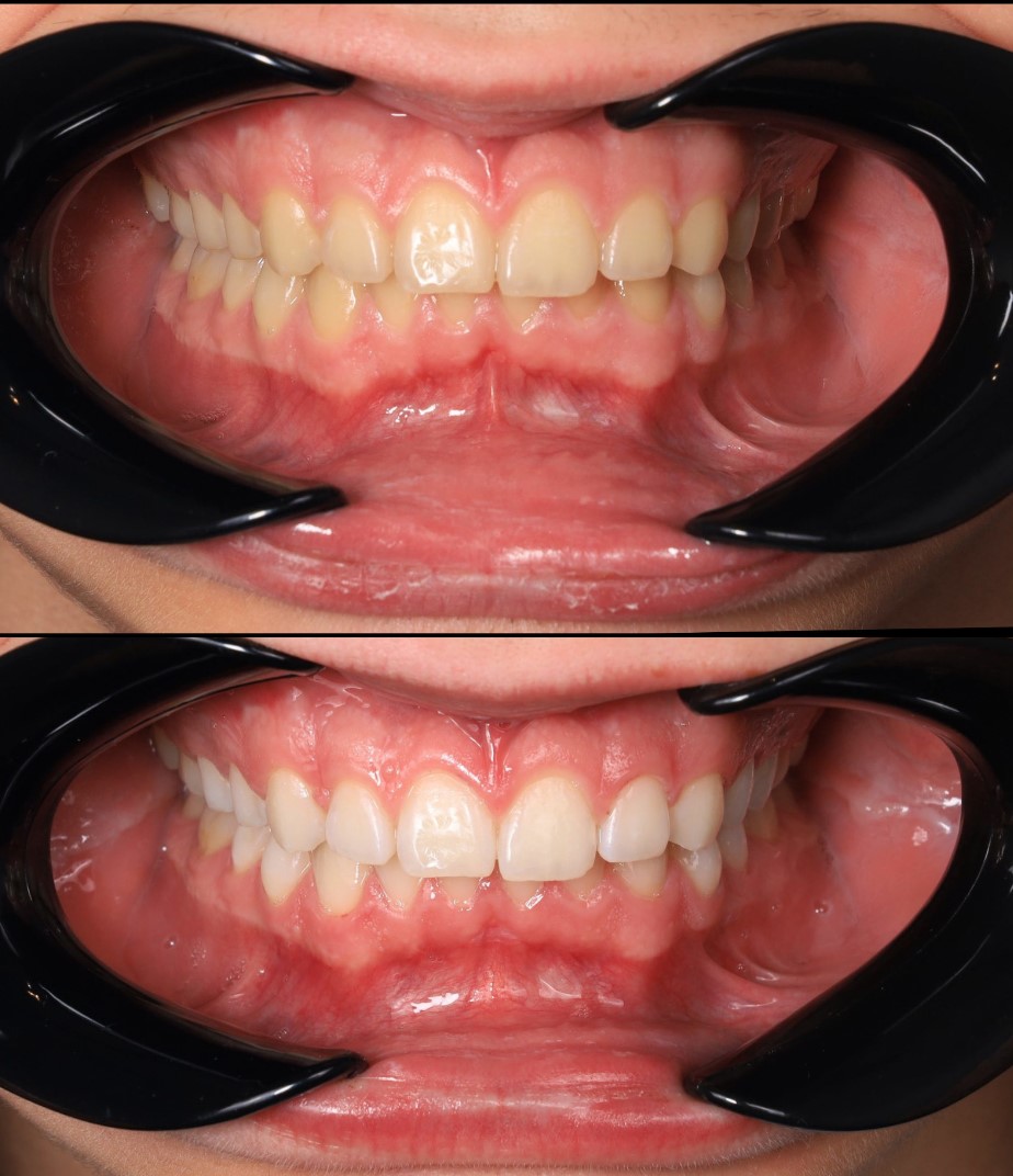 Професійне відбілювання зубів (magic smile) у Львові в Havryk ...