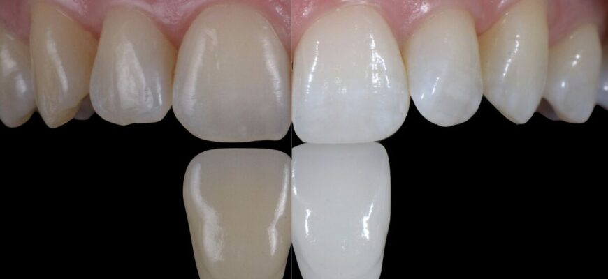 Ефективні методи відбілювання зубів: секрети сяючої посмішки