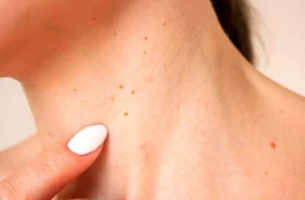 Ефективні методи видалення папілом на шиї: обираємо найкращий спосіб