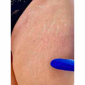 Видалення рубців та розтяжок у Ізмаїлі