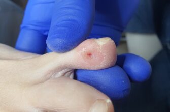 Ефективні методи виведення мозолів на пальцях ніг: поради та засоби