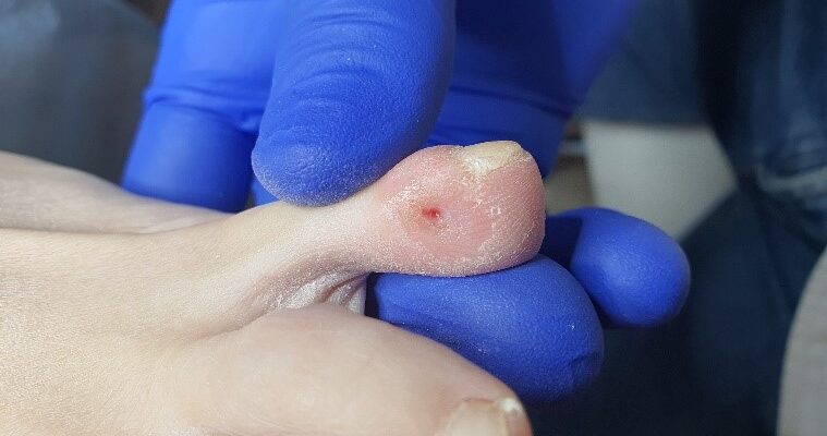 Ефективні методи виведення мозолів на пальцях ніг: поради та засоби