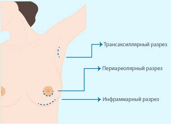Ефективні методи зменшення затвердіння швів після операційних втручань