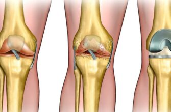 Ефективні методи зняття болю в коліні: поради та рекомендації