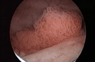 Ефективні методи зняття запалення сечового міхура: поради та рекомендації