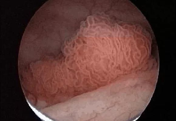 Ефективні методи зняття запалення сечового міхура: поради та рекомендації