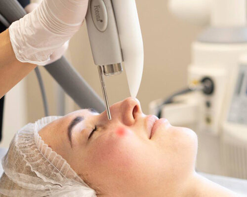 Ефективні способи лікування розацеа: огляд сучасних ліків та методів