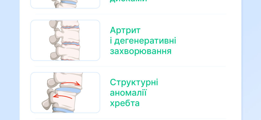 Ефективні способи подолання гострого болю в попереку: поради та лікування