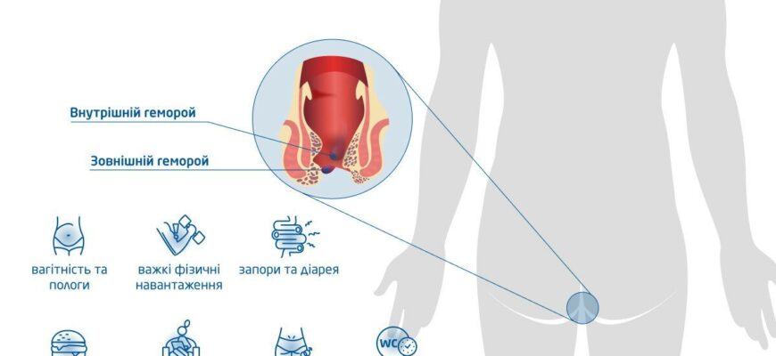 Ефективні способи полегшення болю при геморої: поради та методи