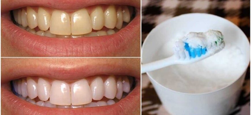 Ефективні способи відбілити зуби в домашніх умовах: поради та засоби
