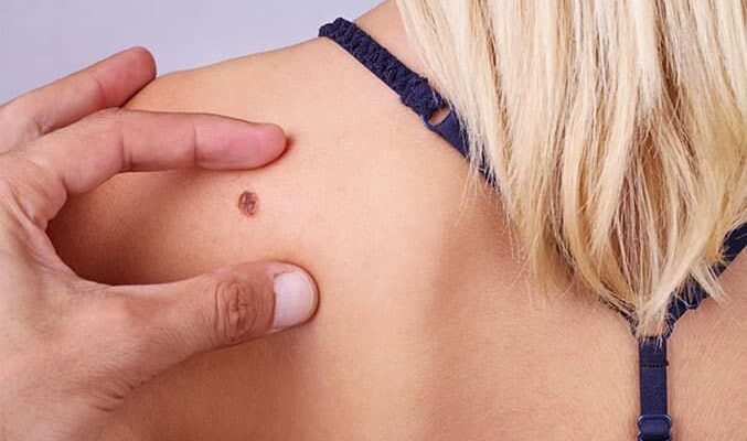 Ефективні способи зняття набряку простати: поради та рекомендації