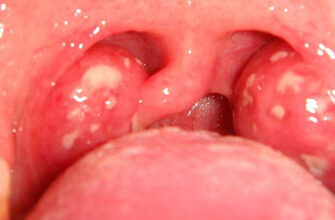 Ефективні способи зняти біль у горлі при ковтанні: поради та методи