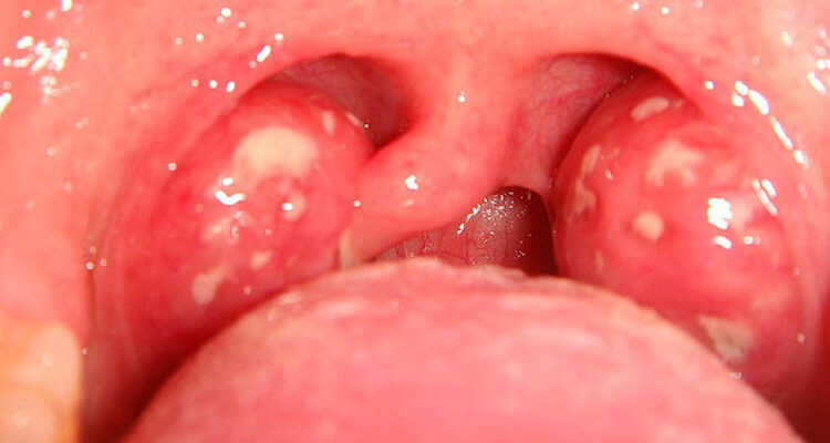 Ефективні способи зняти біль у горлі при ковтанні: поради та методи