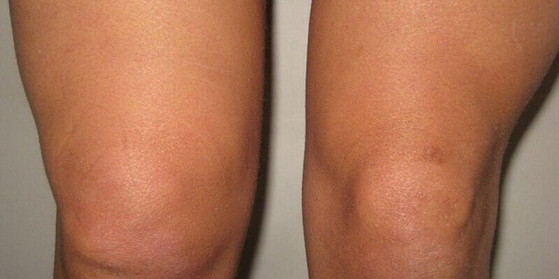 Ефективні способи зняти набряк ніг: домашні методи та поради лікарів